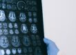 Röntgenbild für Vaskuläre Demenz
